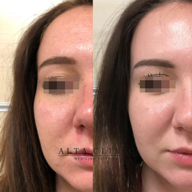 Pelle del viso prima e dopo il peeling biostimolante PRX-T33, foto affiancate, nel centro di medicina estetica di Bergamo