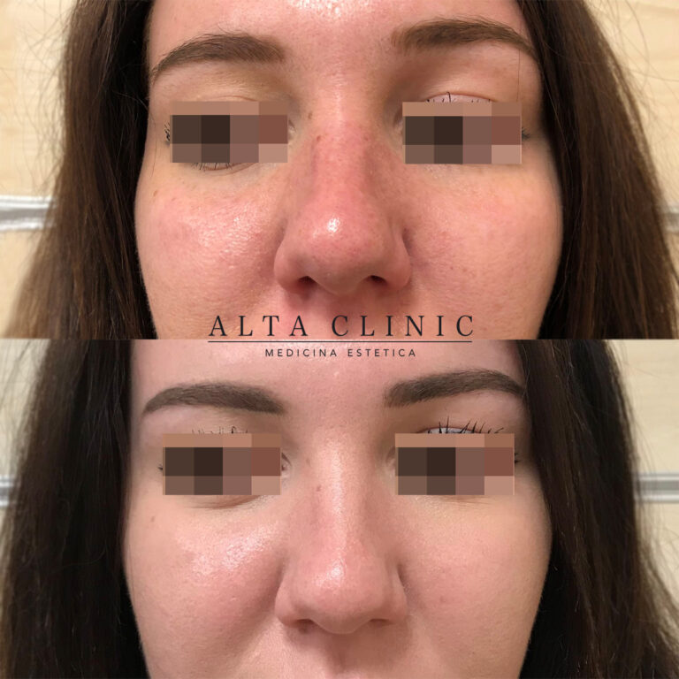 Viso in vista frontale con arrossamenti su naso e guance prima e dopo il peeling PRX-T33 ad Alta Clinic Bergamo