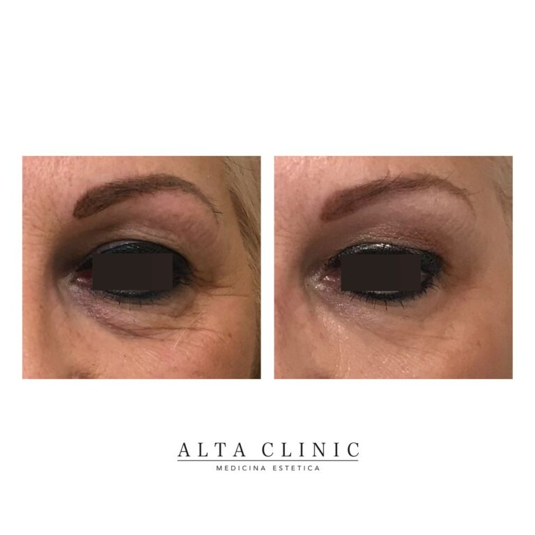 Occhio visto di lato con occhiaie e rughe prima e dopo il filler occhiaie presso Alta Clinic