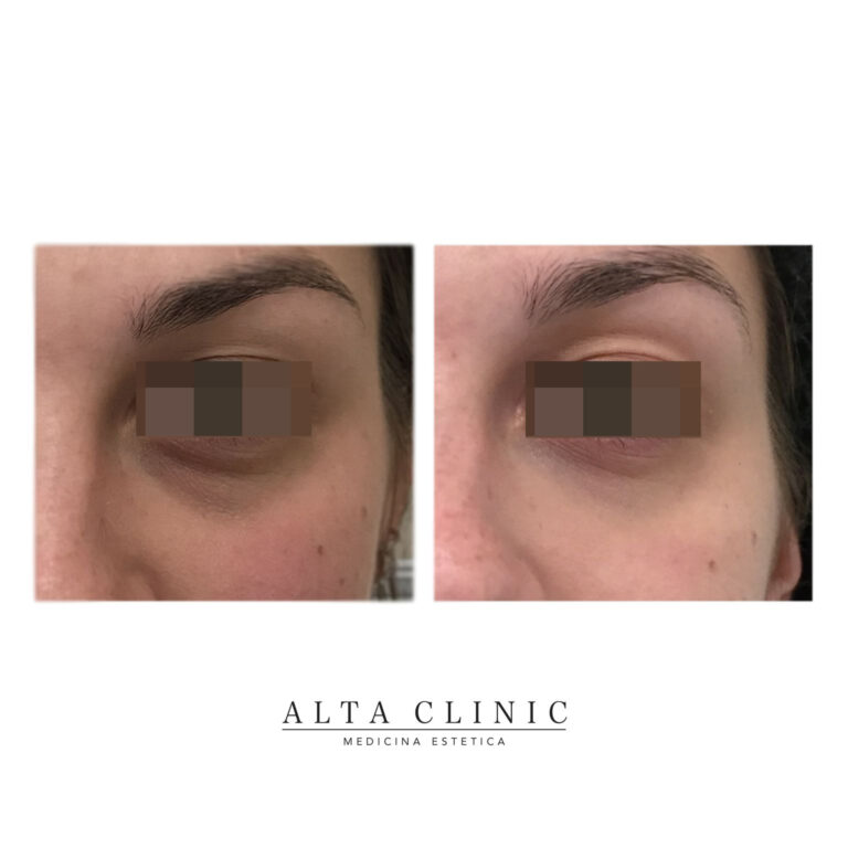Zona sotto l'occhio di tre quarti a confronto prima e dopo il filler occhiaie presso lo studio Alta Clinic