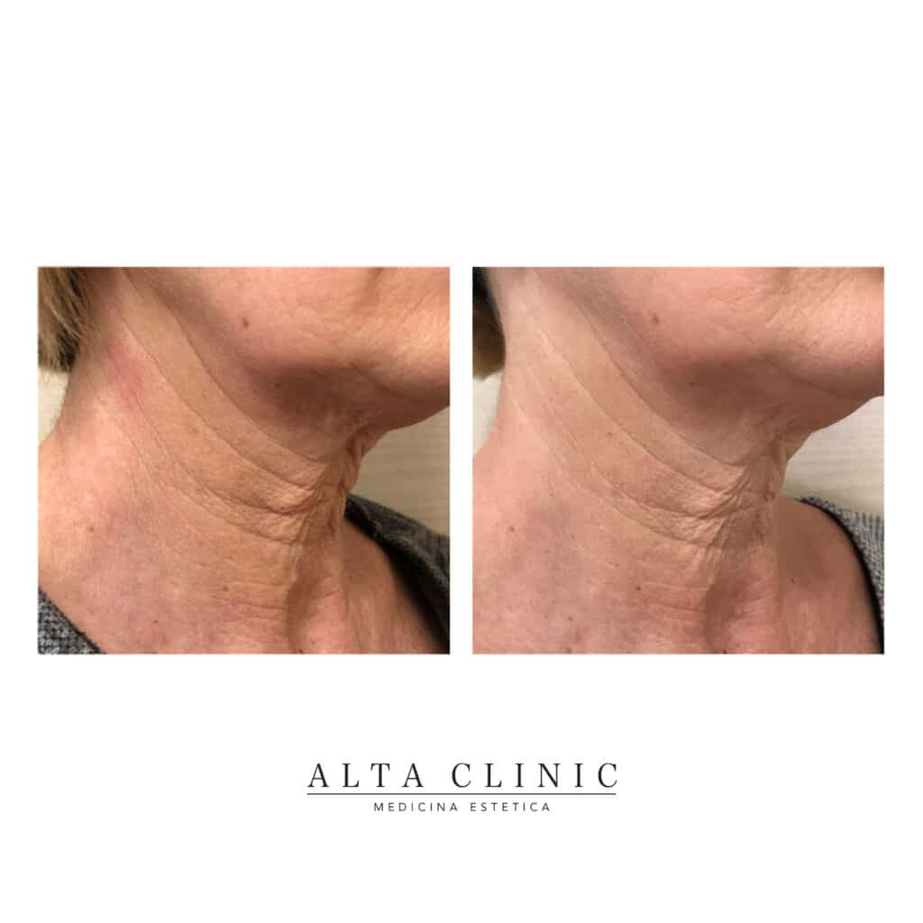 Lifting liquido - Alta Clinic S.r.l