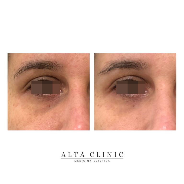 Filler occhiaie a confronto prima e dopo, occhi in vista frontale, trattamento di medicina estetica presso Alta Clinic