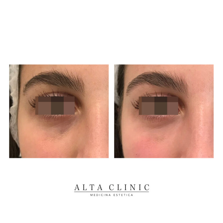 Prima e dopo il riempimento delle occhiaie con acido ialuronico, sguardo frontale, presso lo studio Alta Clinic