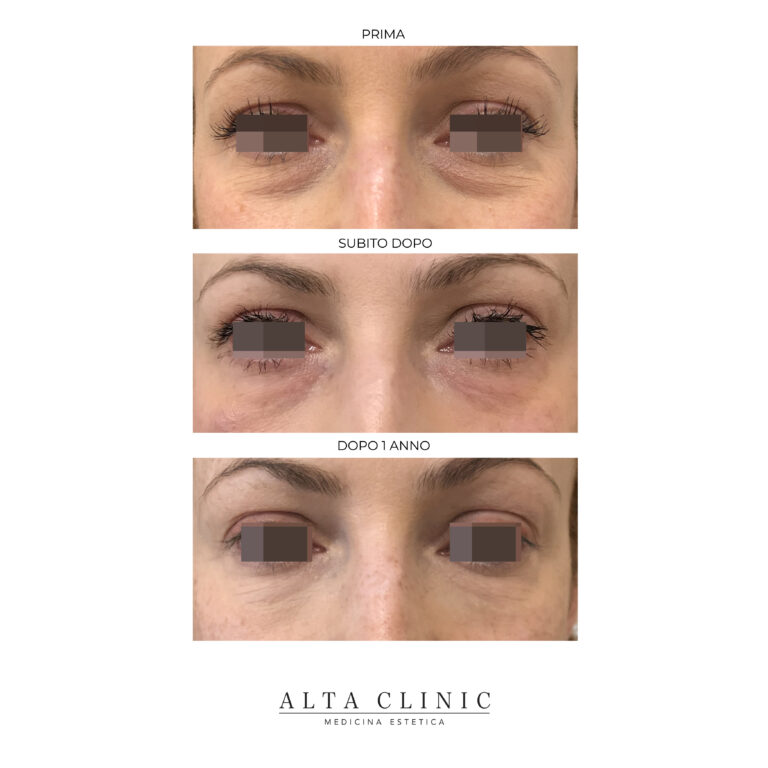 Occhiaie prima del filler, subito dopo e a un anno dal trattamento, sequenza fotografica di Alta Clinic Bergamo