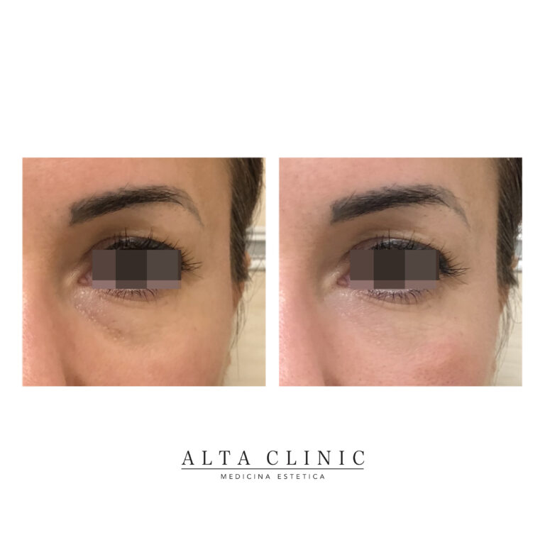 Prima e dopo il filler per occhiaie scure, sguardo frontale, trattamento nel centro di medicina estetica Alta Clinic