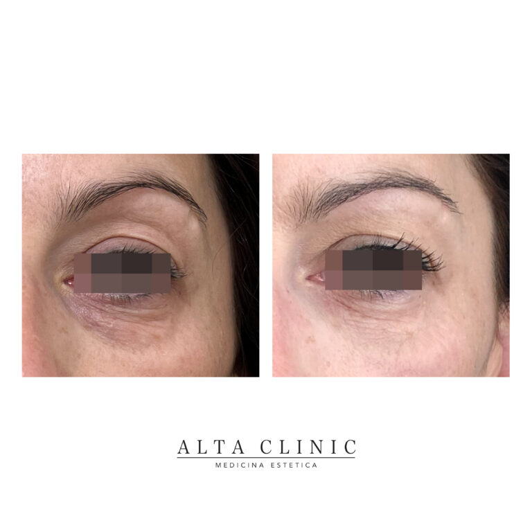Occhio di tre quarti prima e dopo il filler occhiaie con acido ialuronico, presso lo studio Alta Clinic