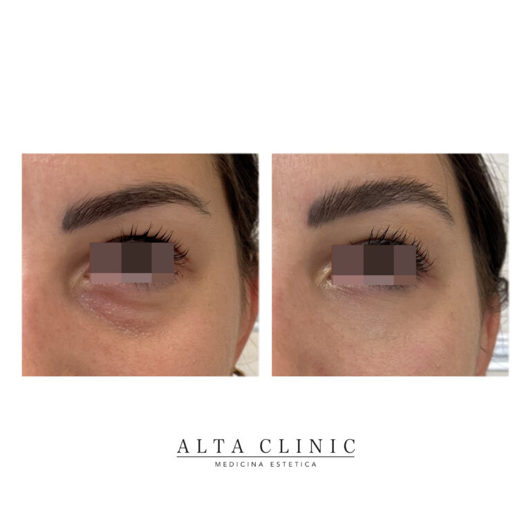 Occhiaie e solco lacrimale prima e dopo il filler con acido ialuronico presso lo studio Alta Clinic