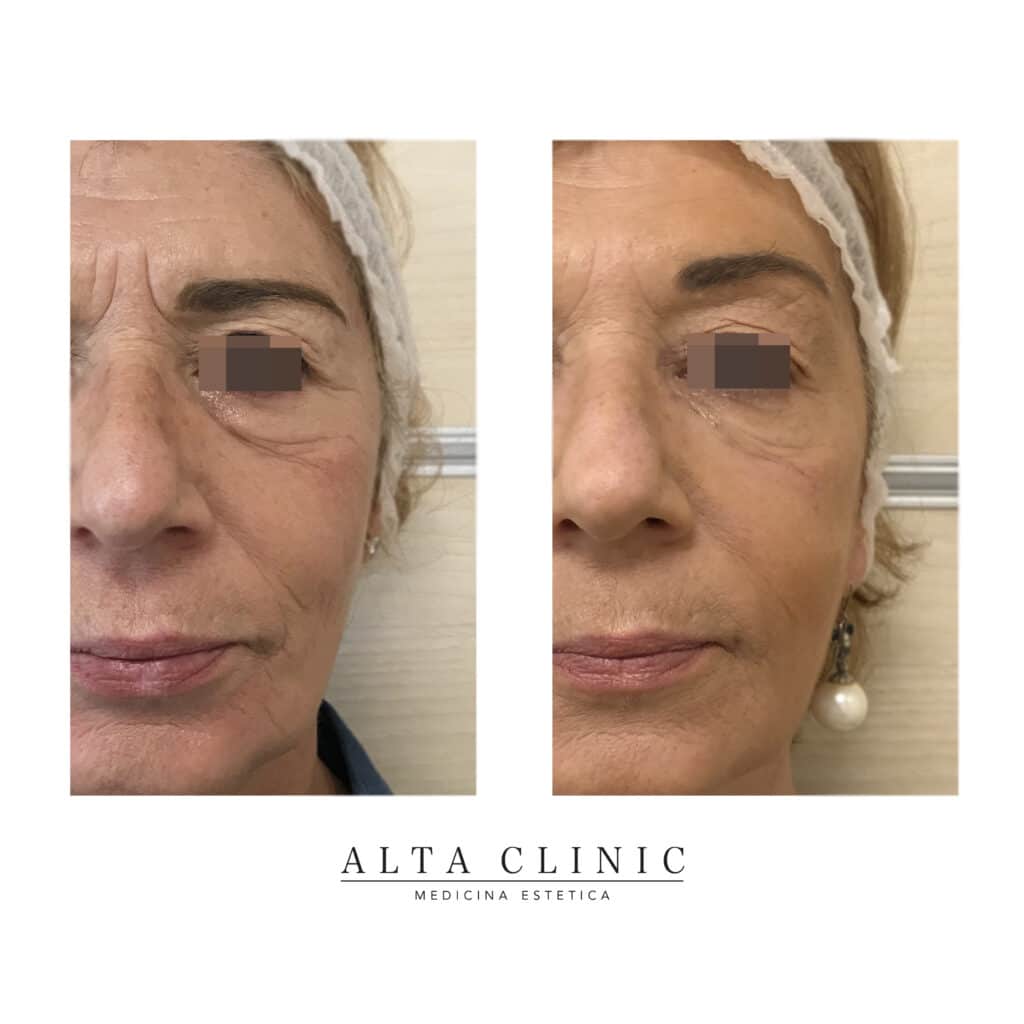 Lifting liquido - Alta Clinic S.r.l