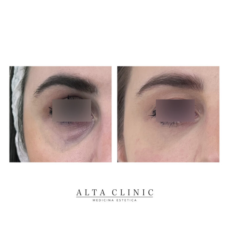 Occhiaie di tre quarti prima e dopo il filler con acido ialuronico eseguito ad Alta Clinic