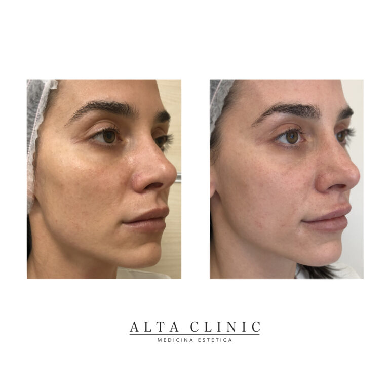 Viso femminile di tre quarti prima e dopo il trattamento Profhilo nel centro di medicina estetica Alta Clinic