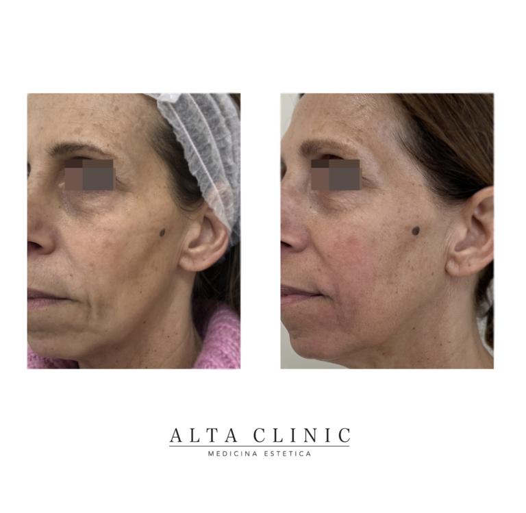 Viso maturo di tre quarti prima e dopo le sedute di Profhilo presso lo studio Alta Clinic