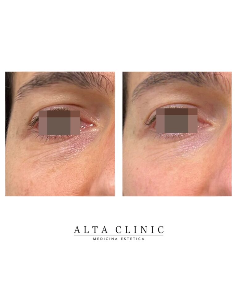 Zona perioculare in vista frontale prima e dopo il filler occhiaie, trattamento eseguito ad Alta Clinic