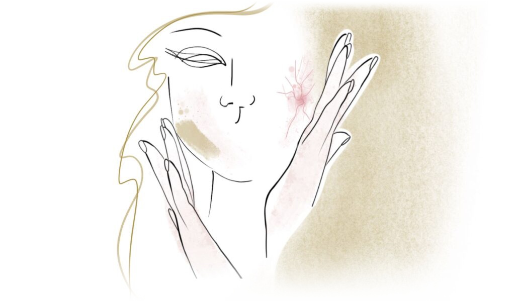 Volto femminile illustrato con mani sulle guance e piccole macchie evidenziate, trattamento laser vascolare a Bergamo