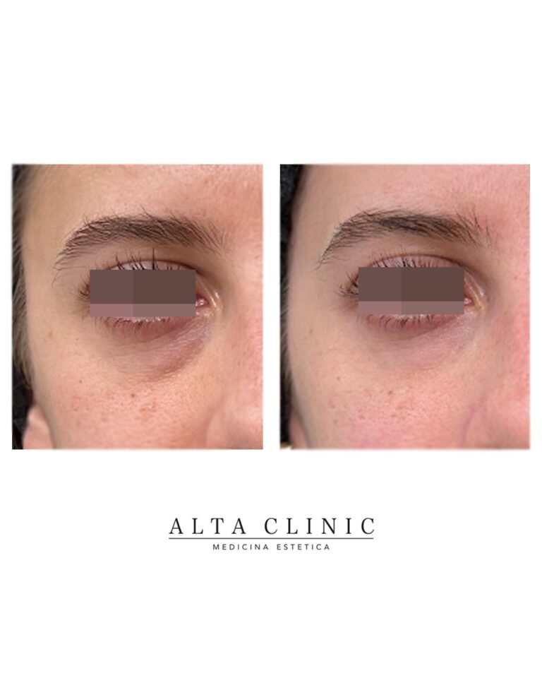 Occhiaie in vista frontale prima e dopo il trattamento filler nel centro di medicina estetica Alta Clinic