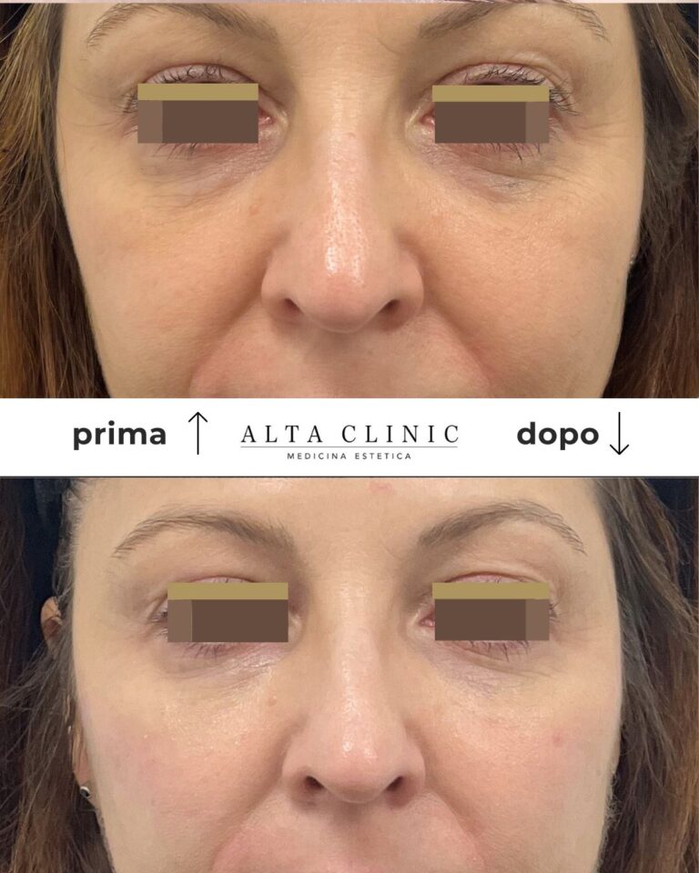 Occhi e zona sotto-oculare in vista frontale, prima in alto e dopo in basso, per un filler occhiaie presso Alta Clinic